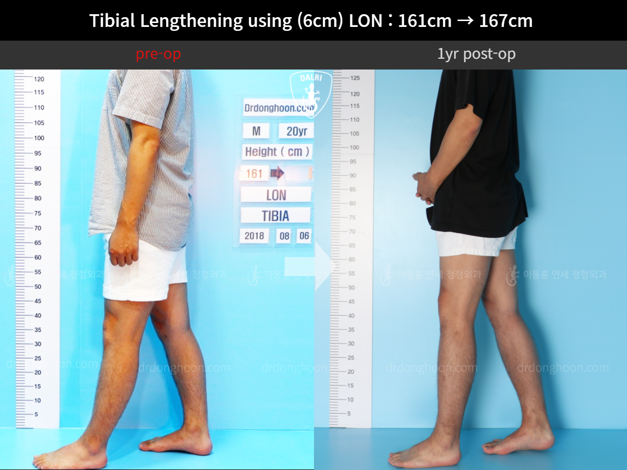 Before and after cll lon, case 11654440, image 6, Dr. Donghoon institute (DALRI)