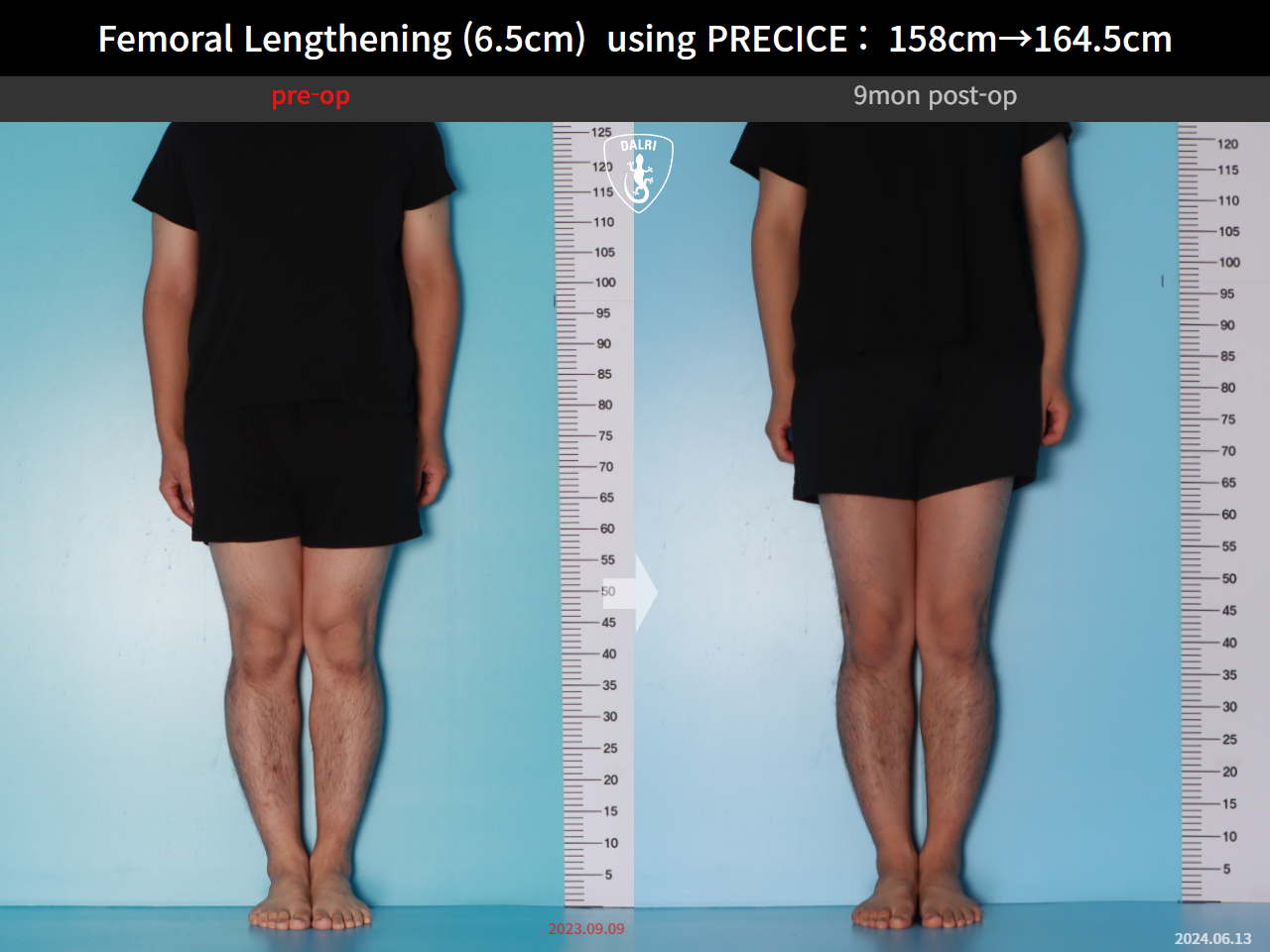 Before and after cll precice, case 28297898, image 1, Dr. Donghoon institute (DALRI)