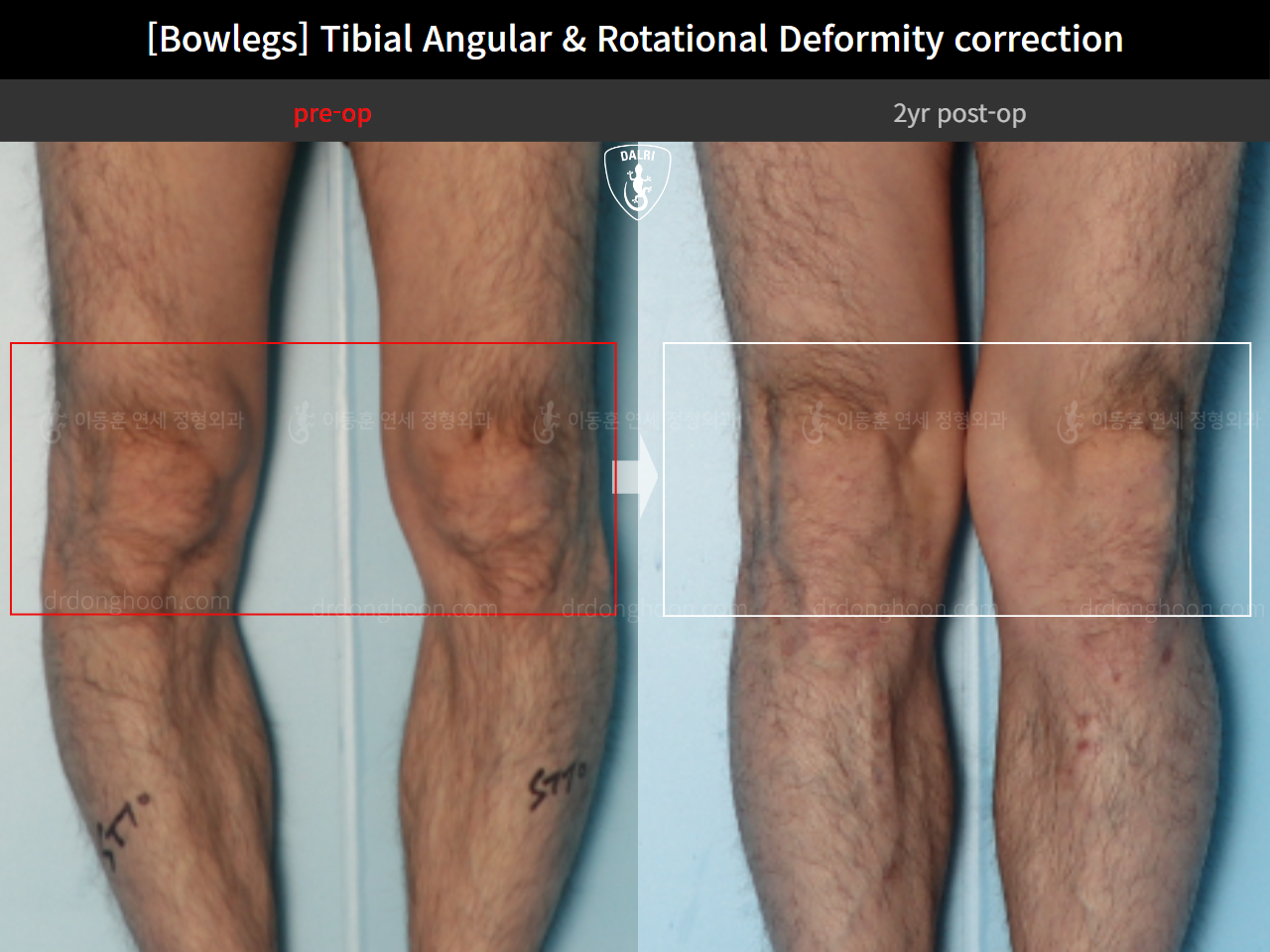 Before and after adult bowlegs, case 16933272, image 7, Dr. Donghoon institute (DALRI)