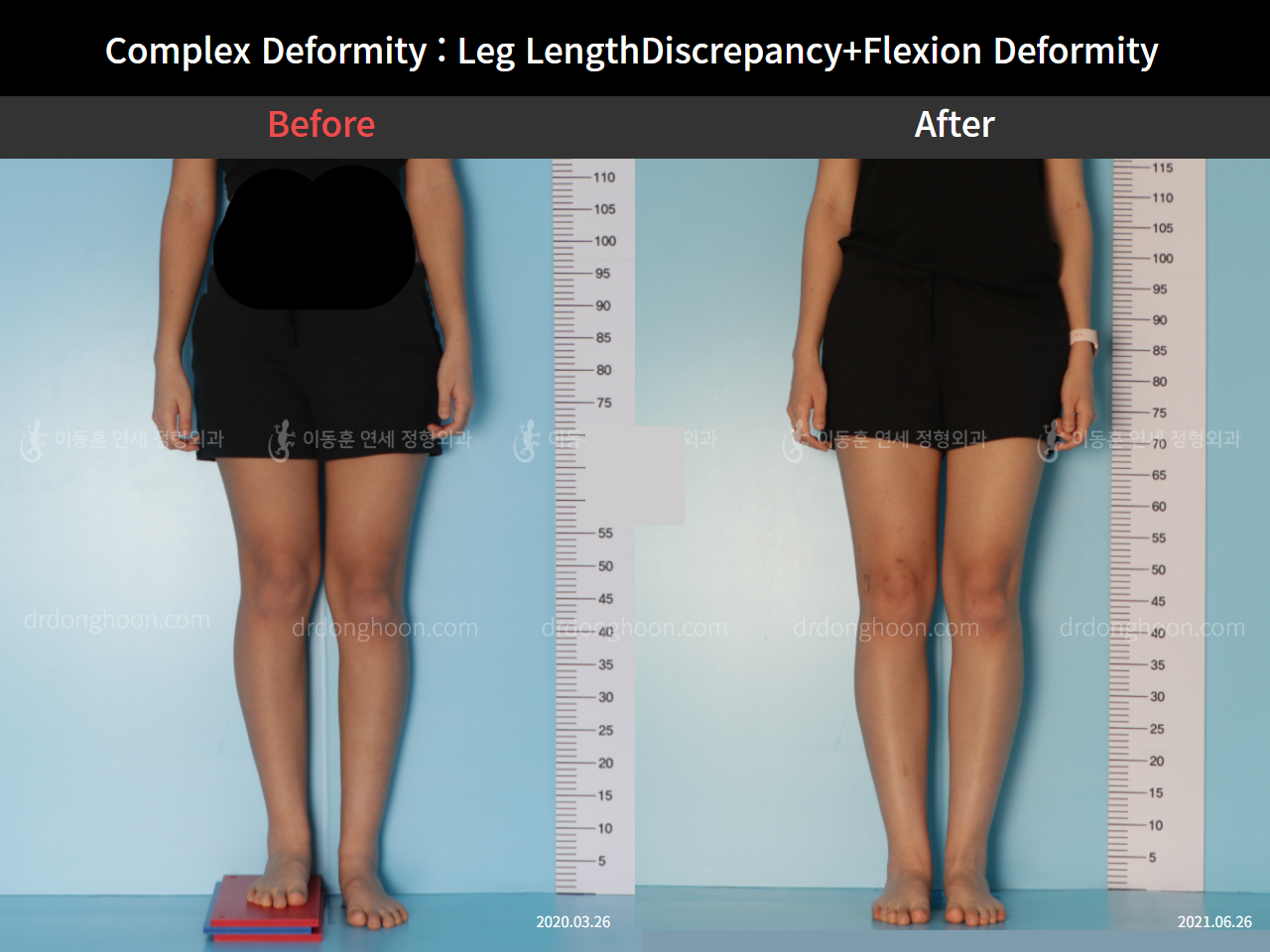 Before and after flexion deformity, case 7397575, image 2, Dr. Donghoon institute (DALRI)