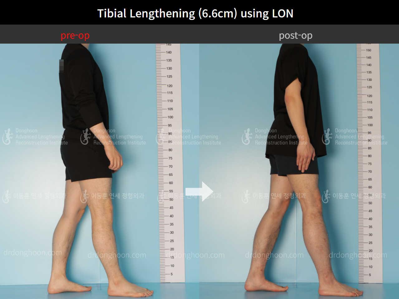 Before and after cll lon, case 8764128, image 3, Dr. Donghoon institute (DALRI)