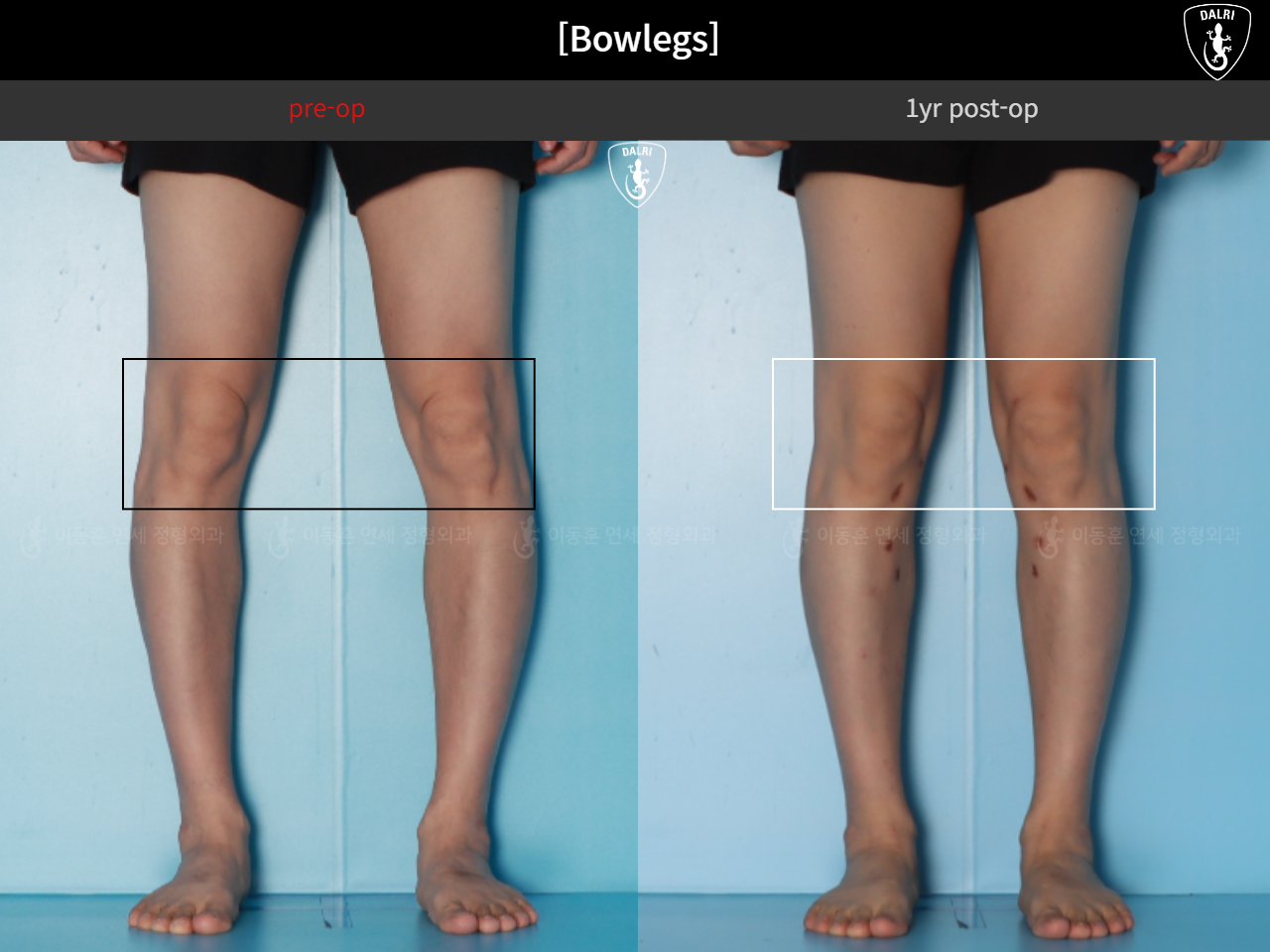 Before and after adult bowlegs, case 125438866, image 10, Dr. Donghoon institute (DALRI)