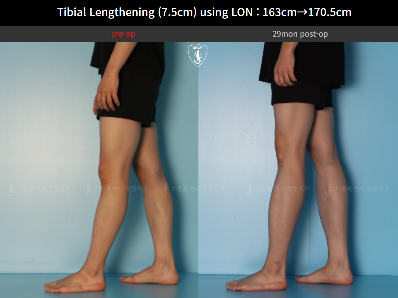Before and after cll lon, case 127341676, image 10, Dr. Donghoon institute (DALRI)