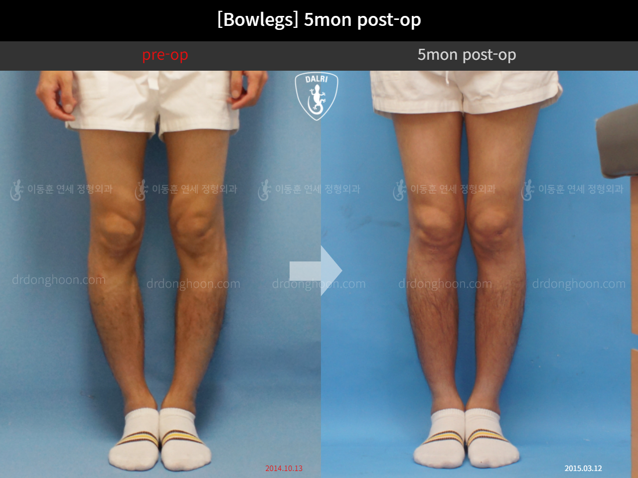 Before and after adult bowlegs, case 4311030, image 3, Dr. Donghoon institute (DALRI)
