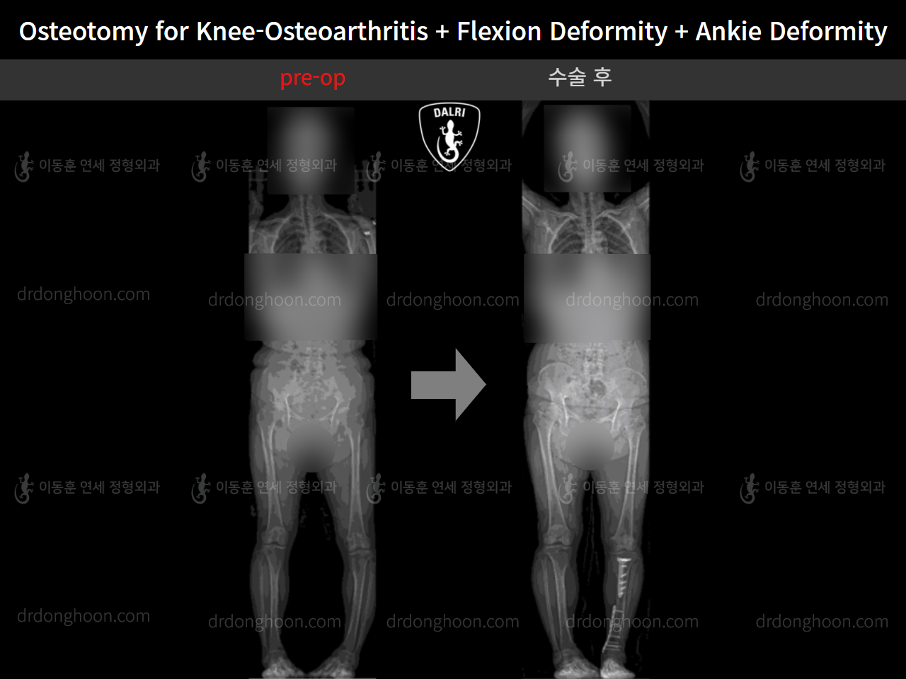 Before and after osteotomy for knee osteoarthritis, case 5315780, image 5, Dr. Donghoon institute (DALRI)