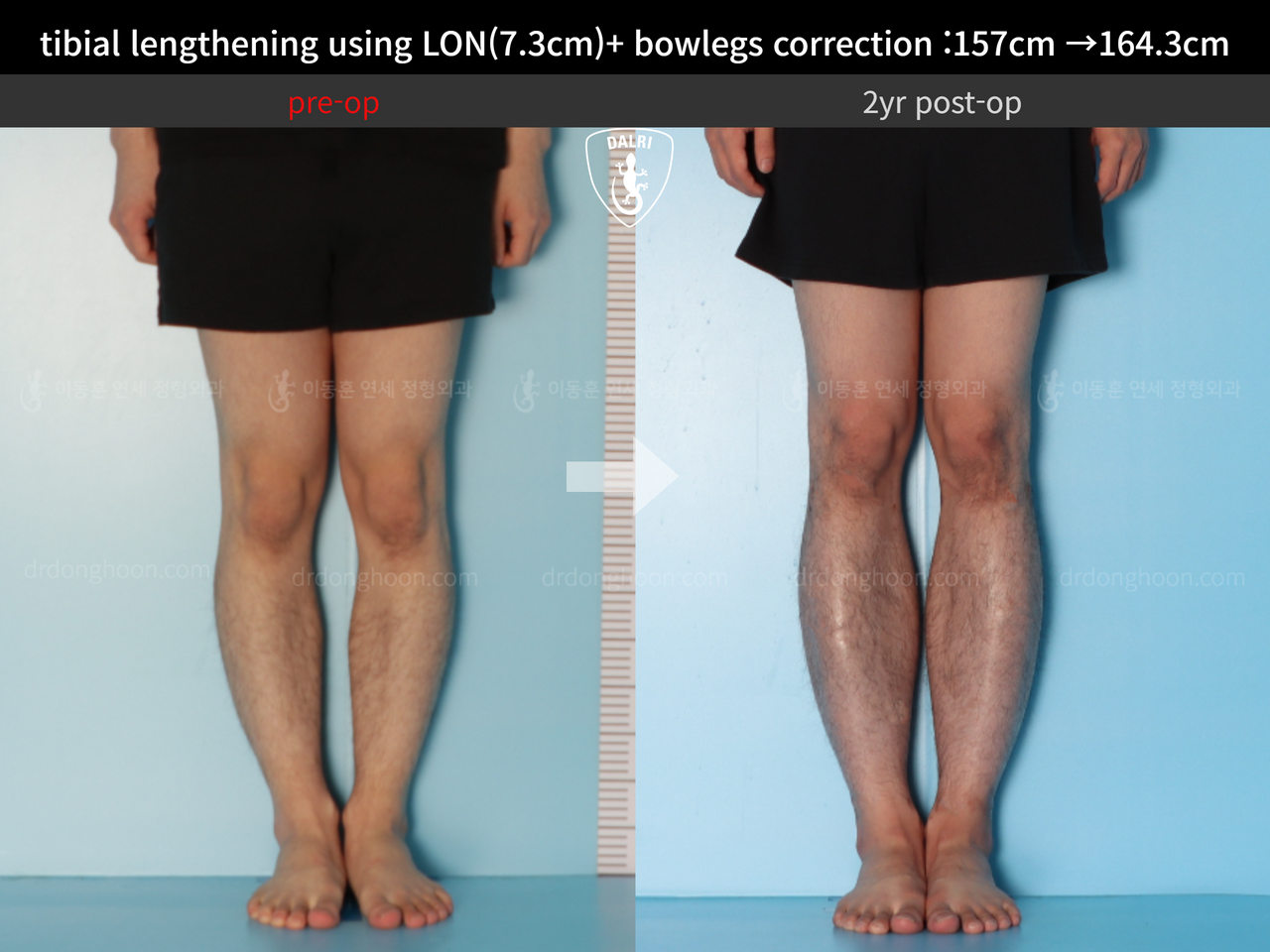 Before and after cll + deformity correction, case 13549500, image 5, Dr. Donghoon institute (DALRI)