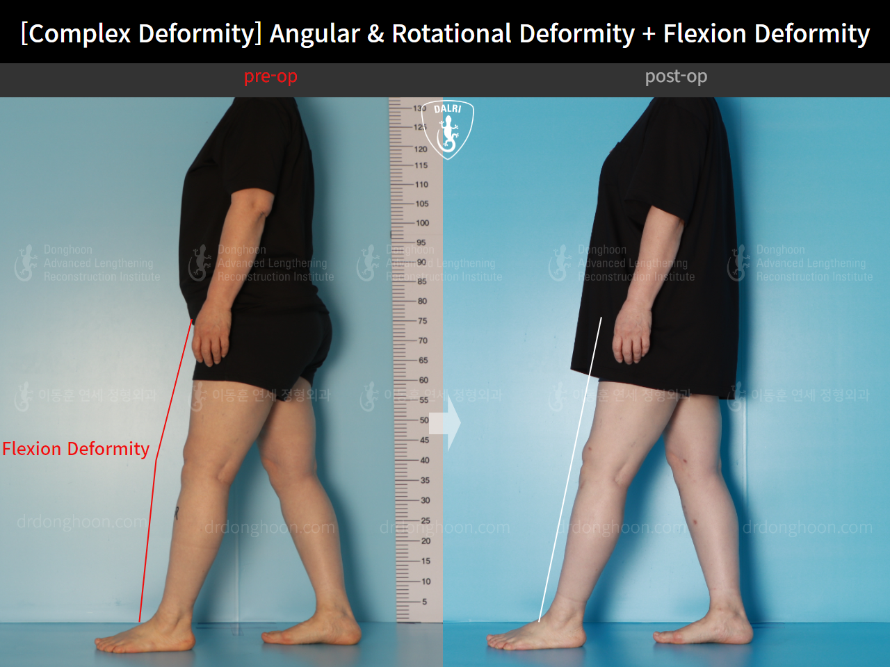 Before and after osteotomy for knee osteoarthritis, case 16781349, image 6, Dr. Donghoon institute (DALRI)