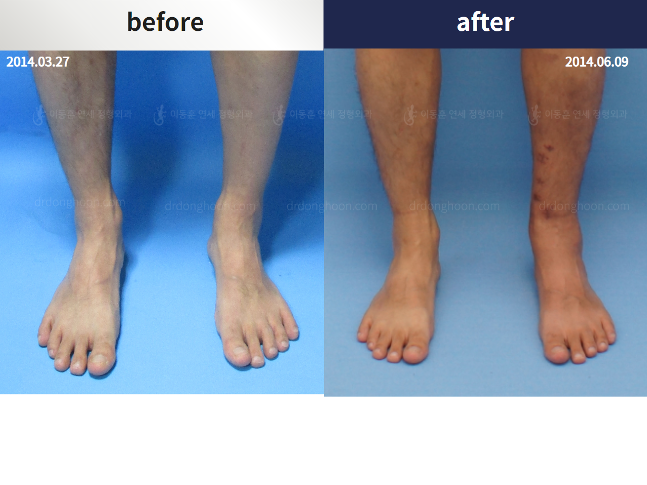 Before and after foot & ankle deformity, case 4246372, image 5, Dr. Donghoon institute (DALRI)