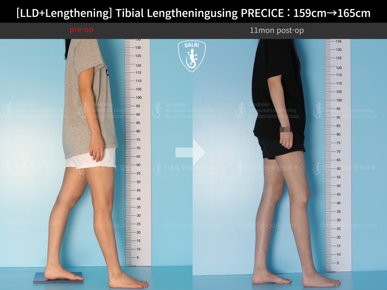 Before and after cll precice, case 13252418, image 4, Dr. Donghoon institute (DALRI)