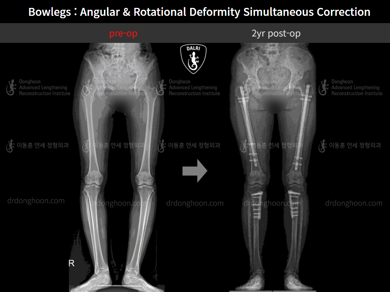 Before and after adult bowlegs, case 4311375, image 8, Dr. Donghoon institute (DALRI)