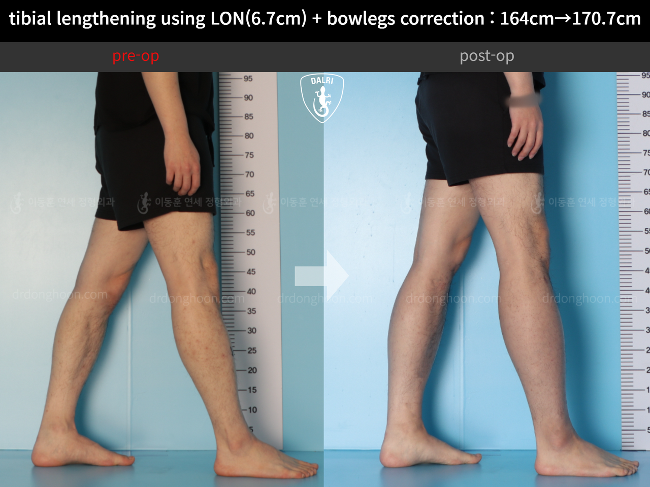Before and after cll + deformity correction, case 13914972, image 9, Dr. Donghoon institute (DALRI)