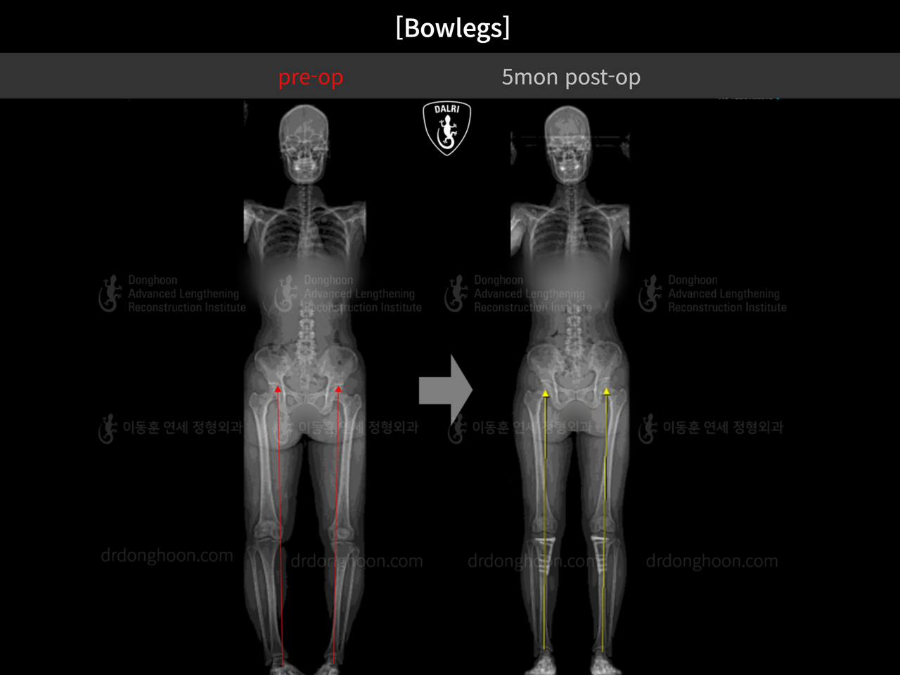 Before and after adult bowlegs, case 13212059, image 9, Dr. Donghoon institute (DALRI)