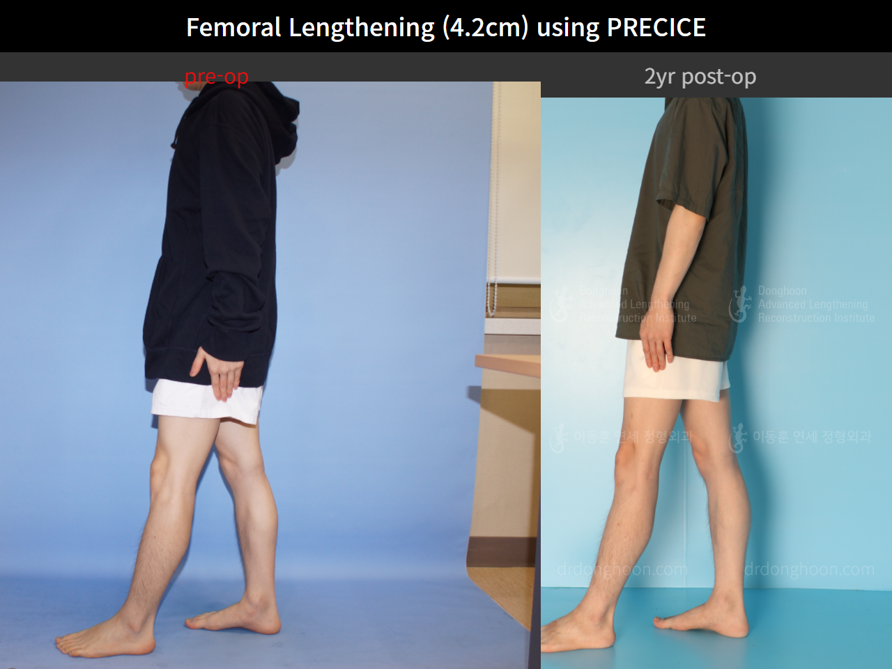 Before and after cll precice, case 4323396, image 4, Dr. Donghoon institute (DALRI)
