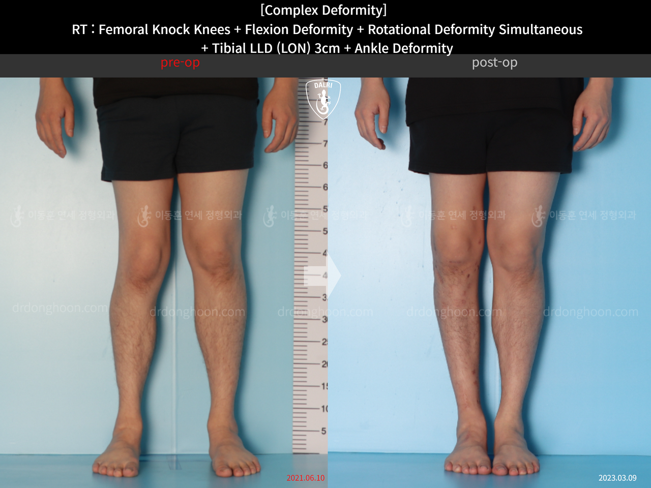 Before and after adult lld, case 14286604, image 5, Dr. Donghoon institute (DALRI)