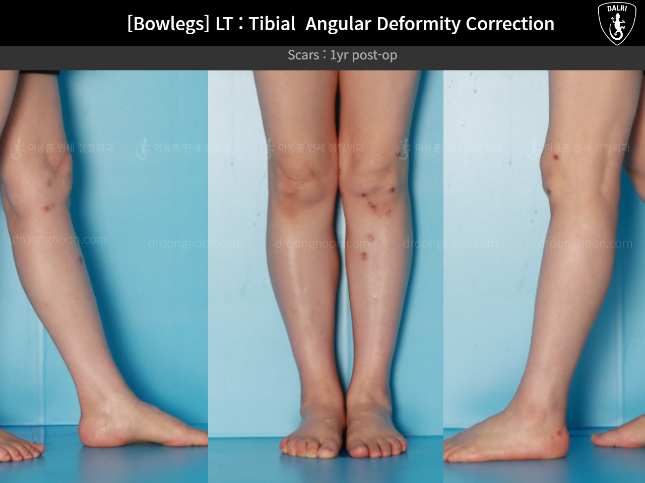Before and after adult bowlegs, case 16787003, image 8, Dr. Donghoon institute (DALRI)