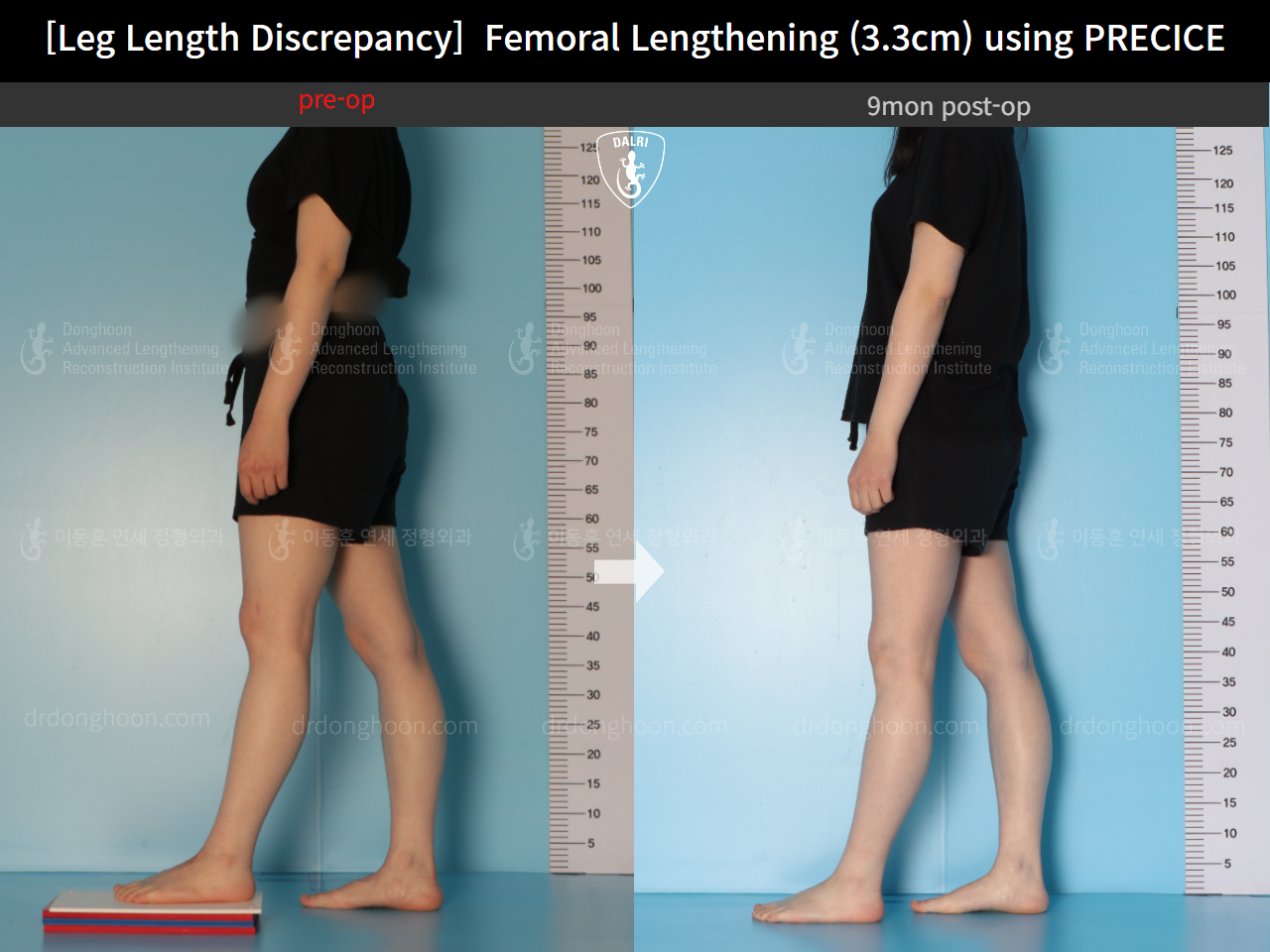 Before and after adult lld, case 14602297, image 3, Dr. Donghoon institute (DALRI)