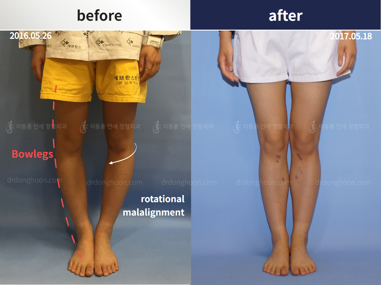 Before and after complex deformity, case 4251615, image 1, Dr. Donghoon institute (DALRI)