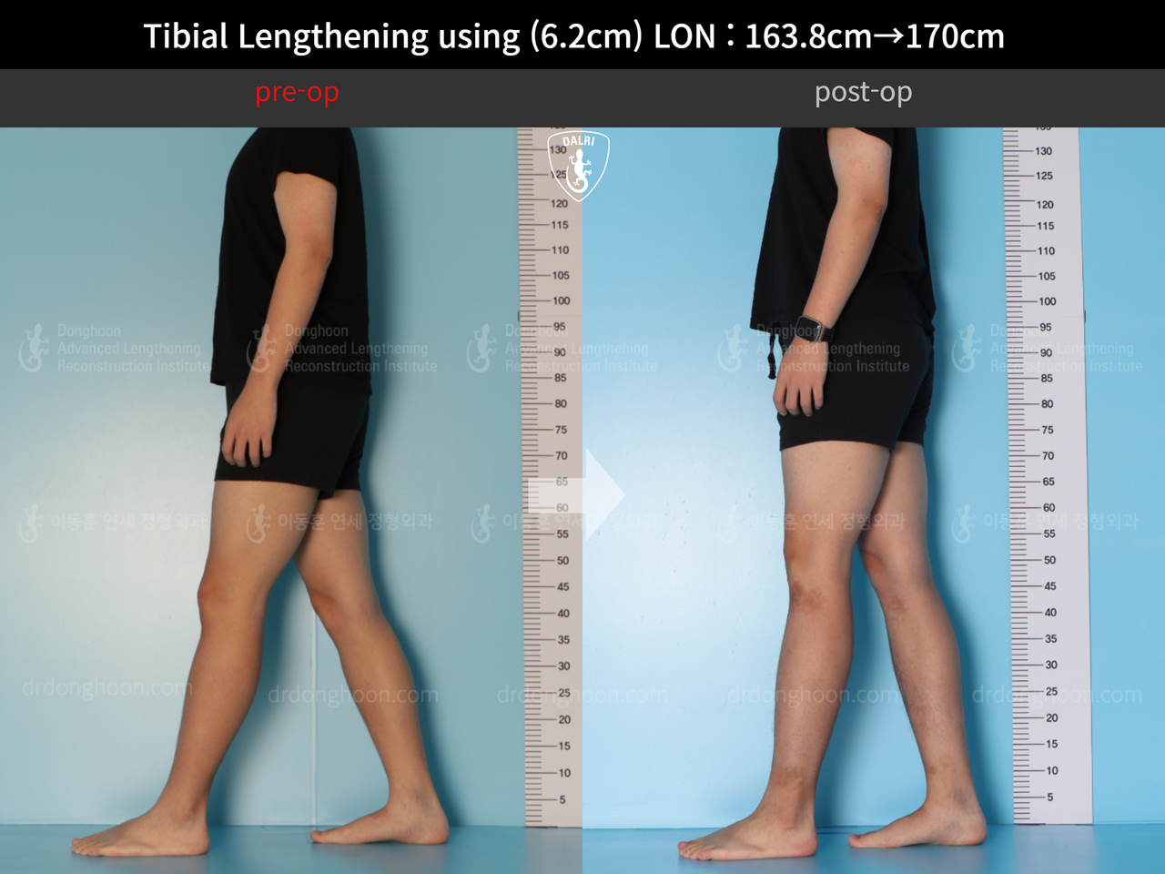 Before and after cll lon, case 13001983, image 3, Dr. Donghoon institute (DALRI)