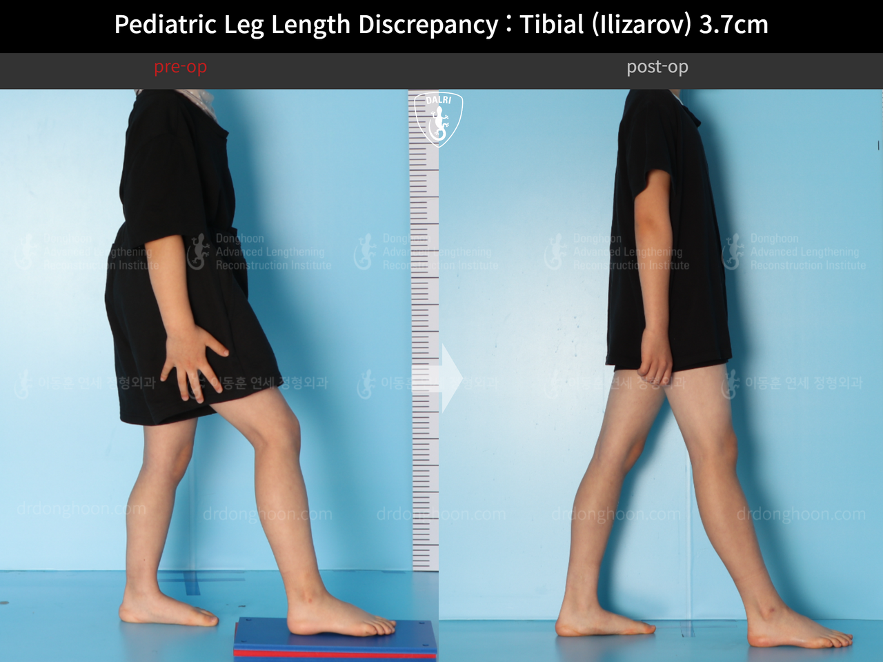 Before and after paediatric & adolescent lld, case 14220900, image 4, Dr. Donghoon institute (DALRI)