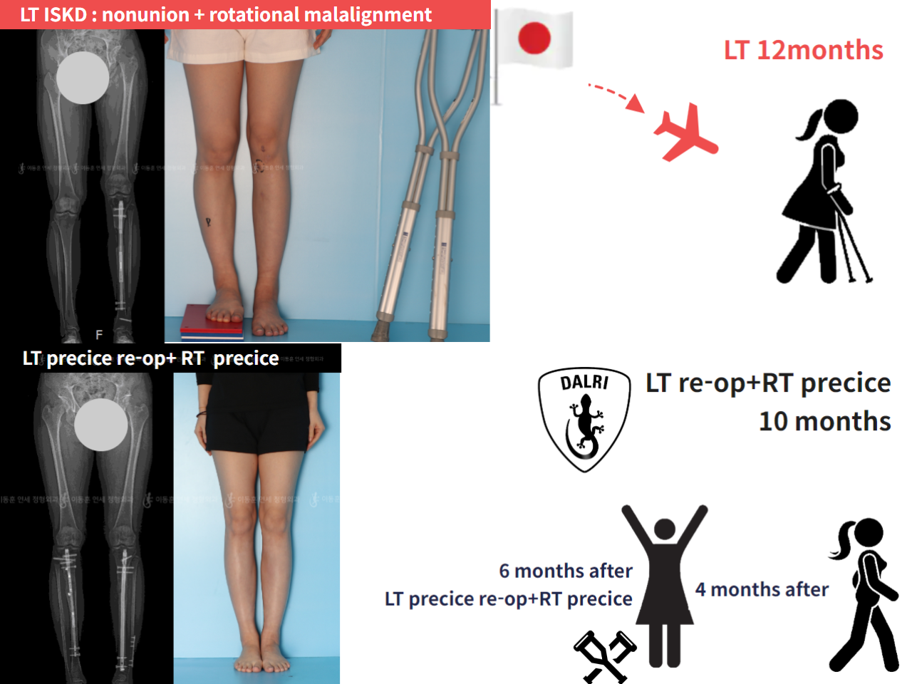 Before and after re-operation for cll, case 4528255, image 1, Dr. Donghoon institute (DALRI)