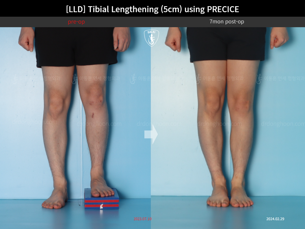 Before and after adult lld, case 18471613, image 5, Dr. Donghoon institute (DALRI)