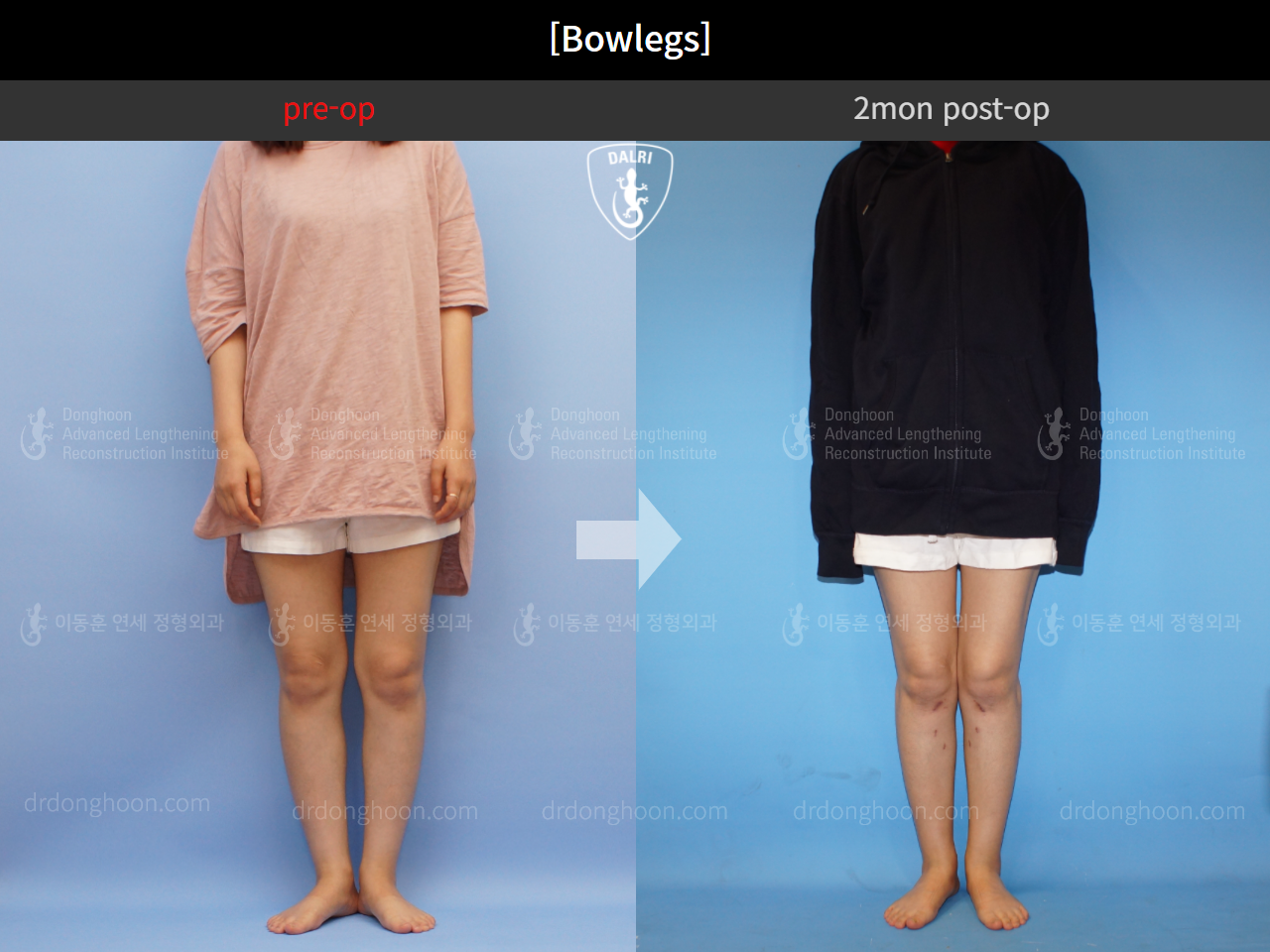 Adult Bowlegs 2mon postop Adult Bowlegs