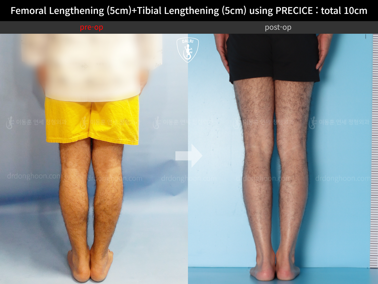 Before and after cll precice, case 13390688, image 6, Dr. Donghoon institute (DALRI)