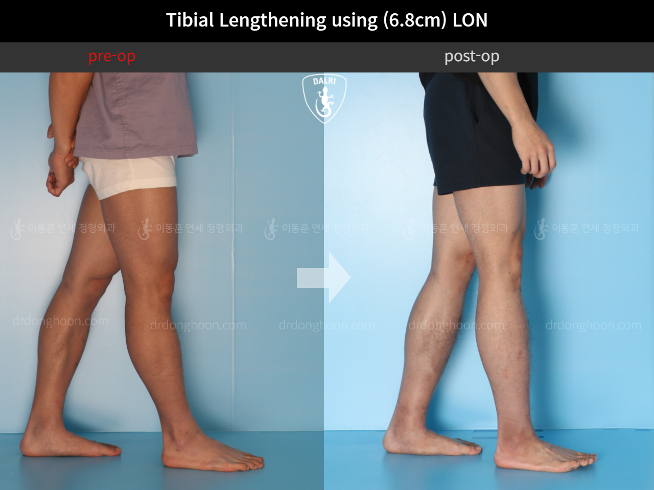 Before and after cll lon, case 4577738, image 8, Dr. Donghoon institute (DALRI)
