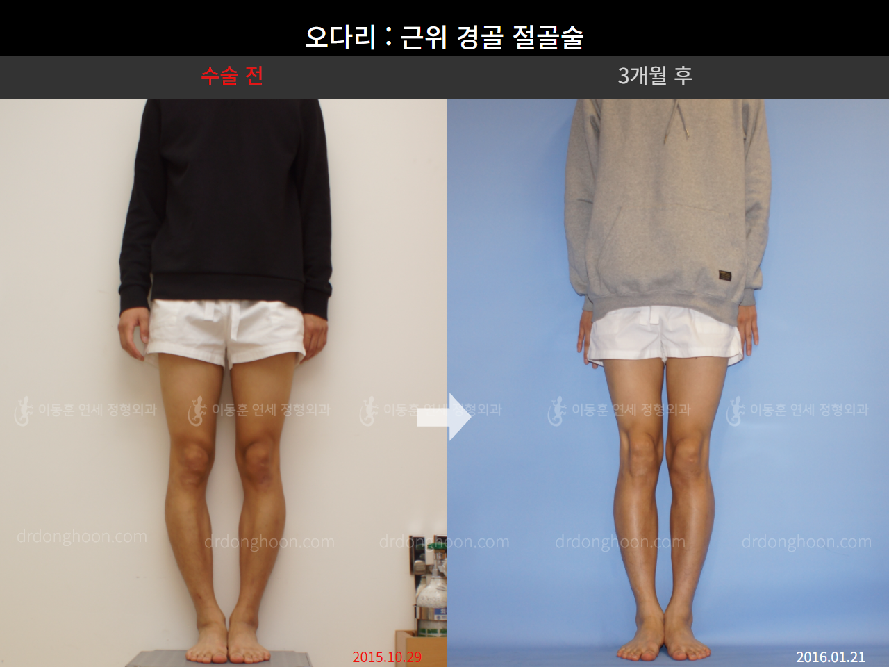 Before and after adult bowlegs, case 4311351, image 1, Dr. Donghoon institute (DALRI)