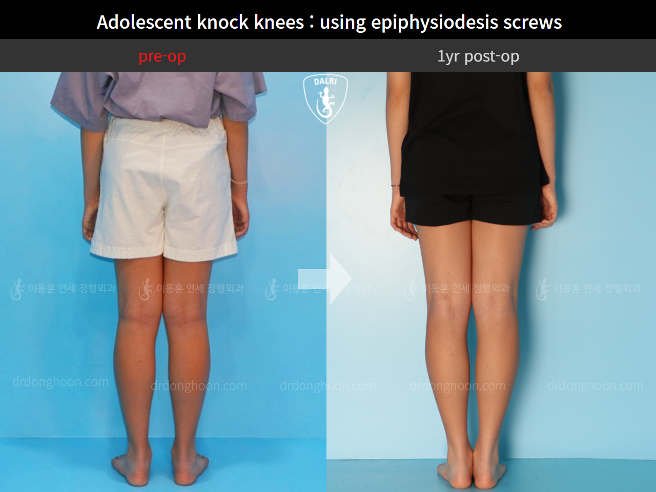 Before and after paediatric & adolescent knock knees, case 4310931, image 2, Dr. Donghoon institute (DALRI)