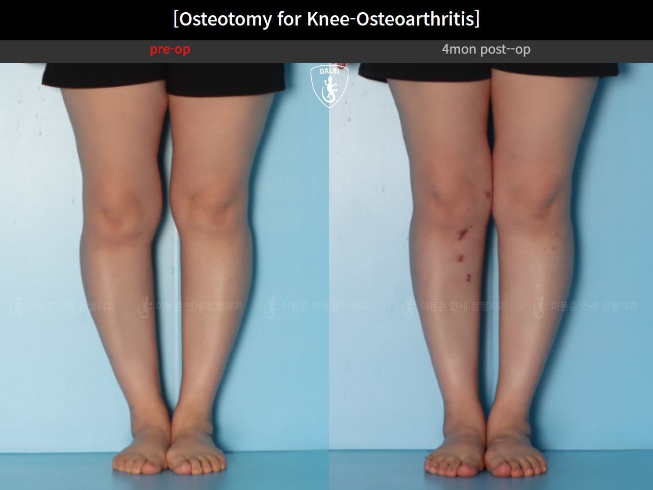 Before and after osteotomy for knee osteoarthritis, case 39778471, image 8, Dr. Donghoon institute (DALRI)