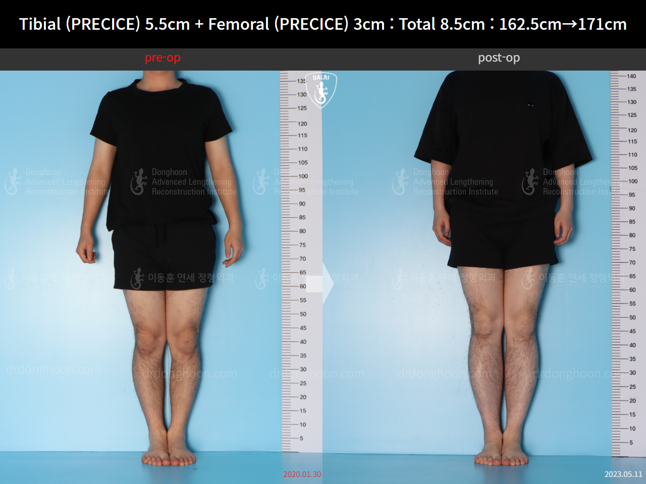 Before and after cll precice, case 15140008, image 2, Dr. Donghoon institute (DALRI)