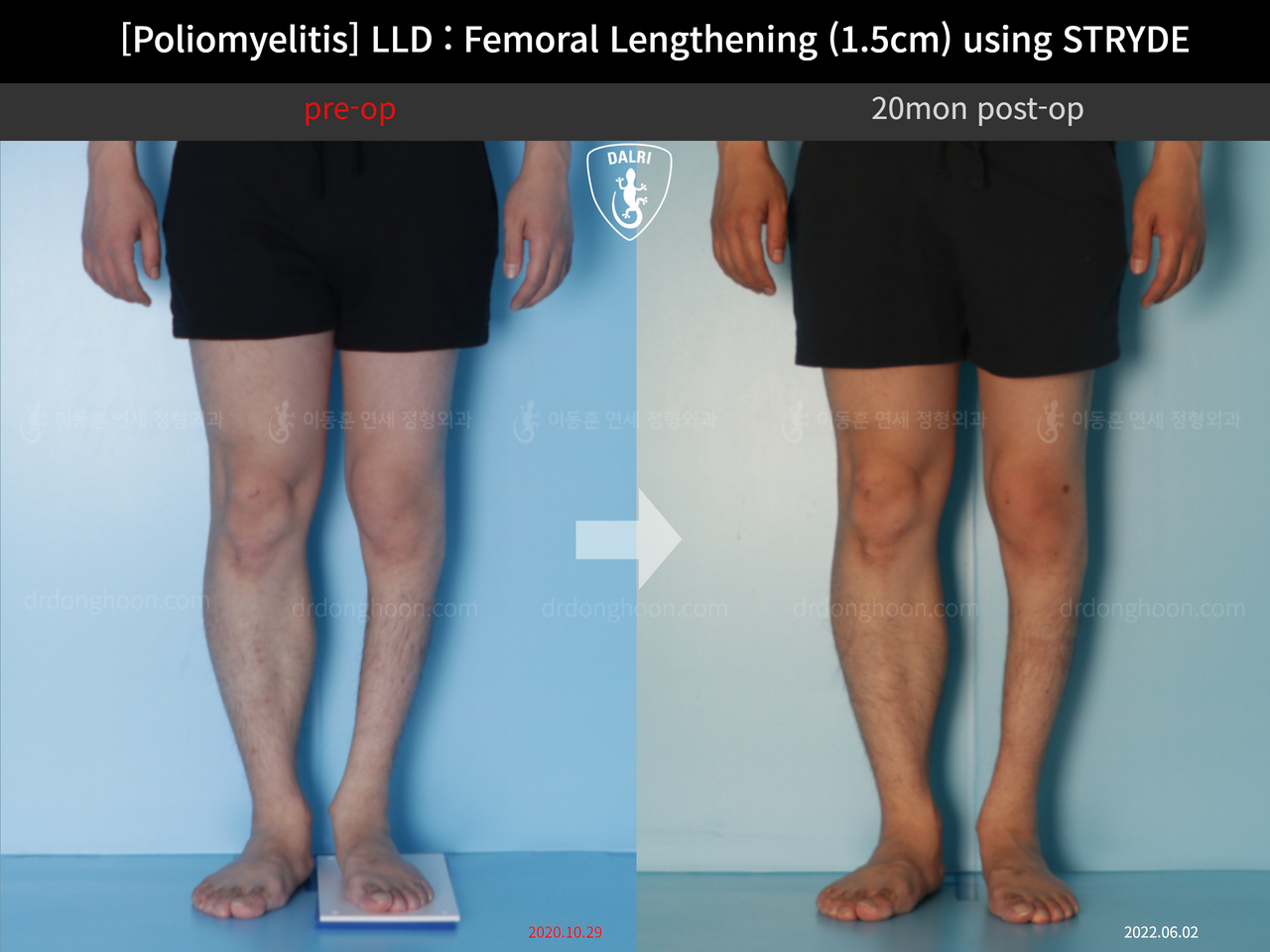 Before and after adult lld, case 12335486, image 4, Dr. Donghoon institute (DALRI)
