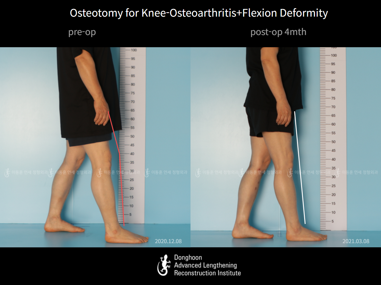 Before and after osteotomy for knee osteoarthritis, case 6754519, image 2, Dr. Donghoon institute (DALRI)