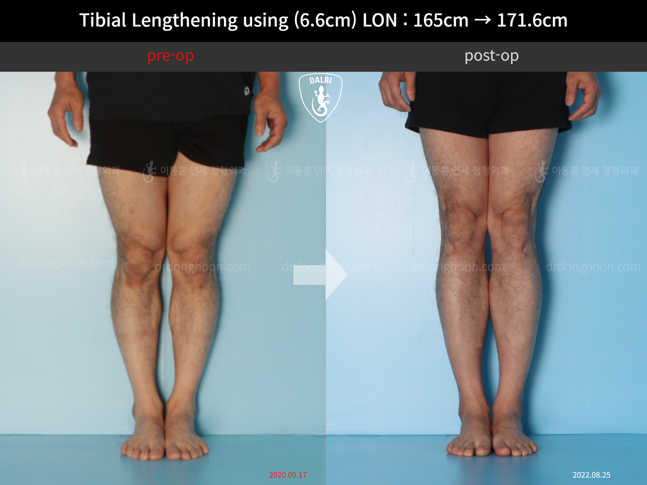 Before and after cll lon, case 12679338, image 5, Dr. Donghoon institute (DALRI)