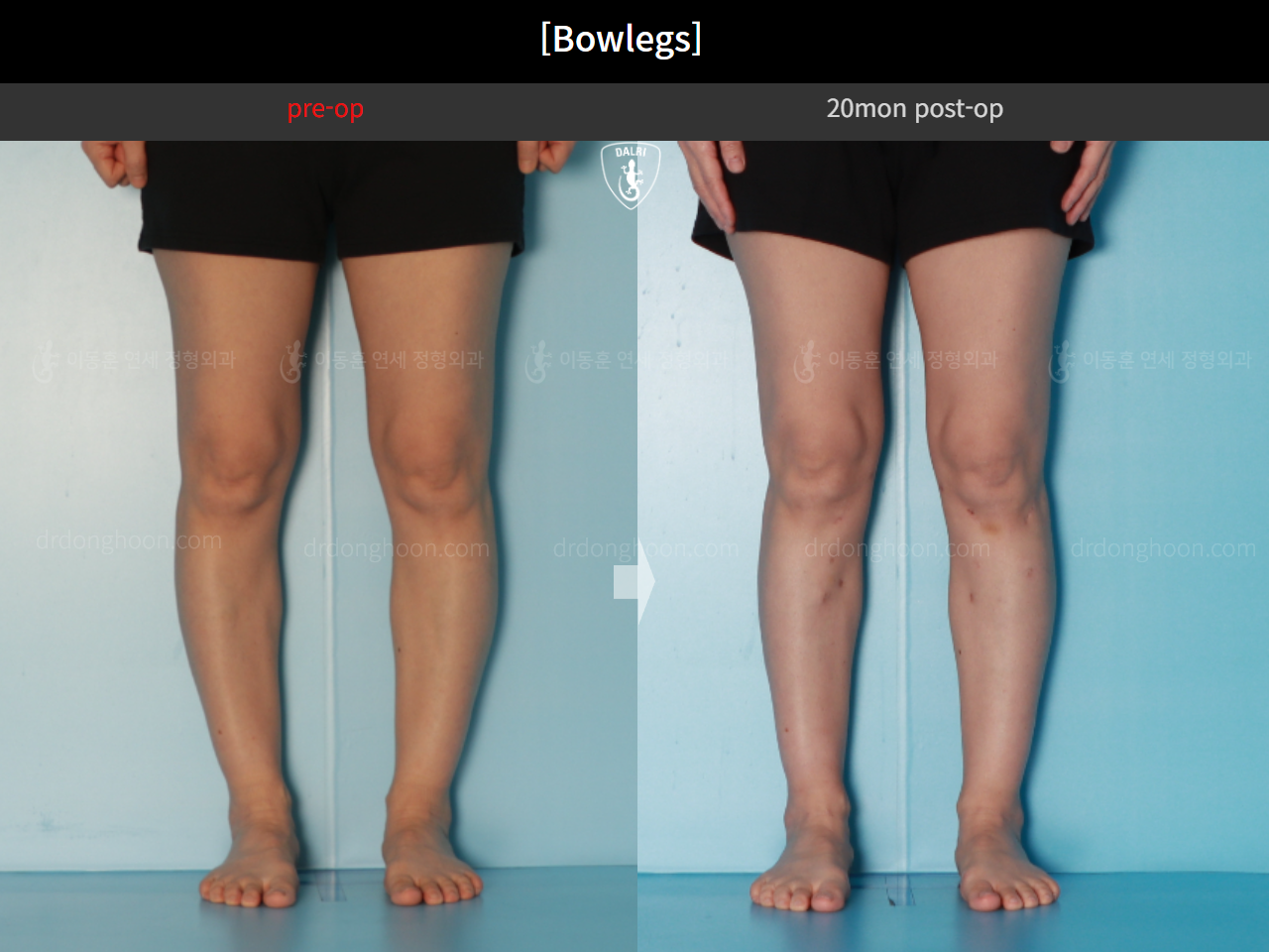 Before and after adult bowlegs, case 16724630, image 6, Dr. Donghoon institute (DALRI)
