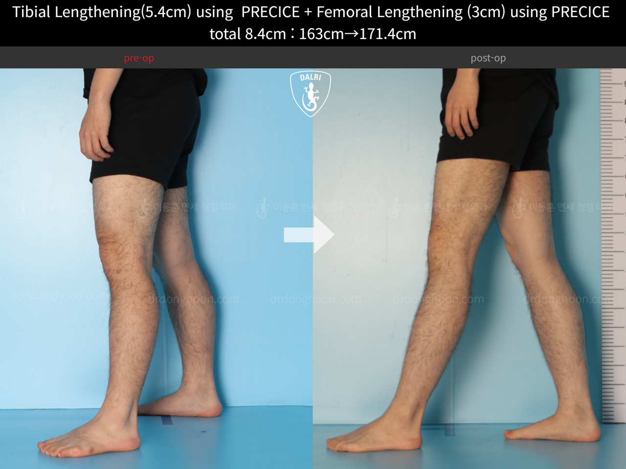 Before and after cll precice, case 12051302, image 9, Dr. Donghoon institute (DALRI)