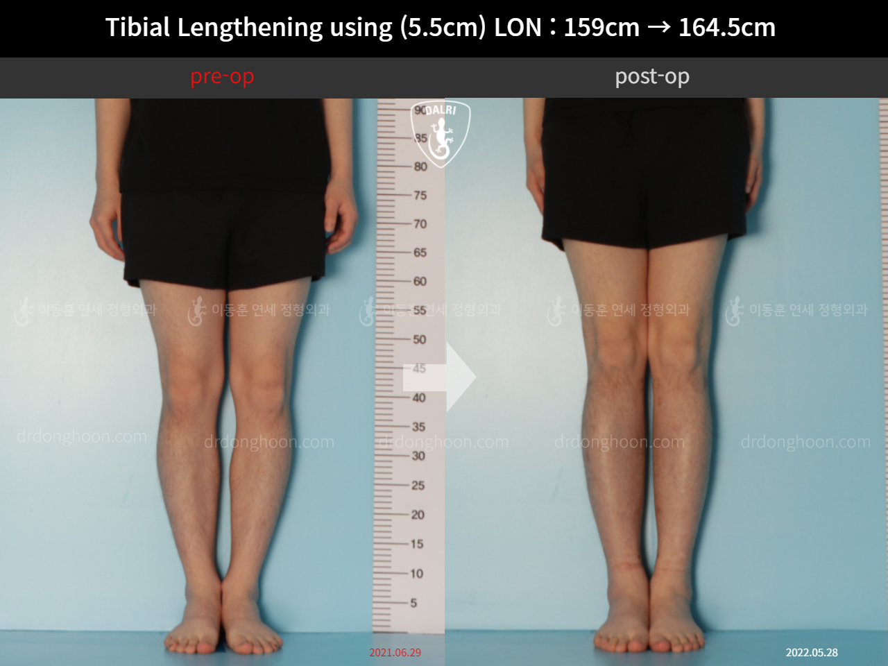 Before and after cll lon, case 11747999, image 4, Dr. Donghoon institute (DALRI)