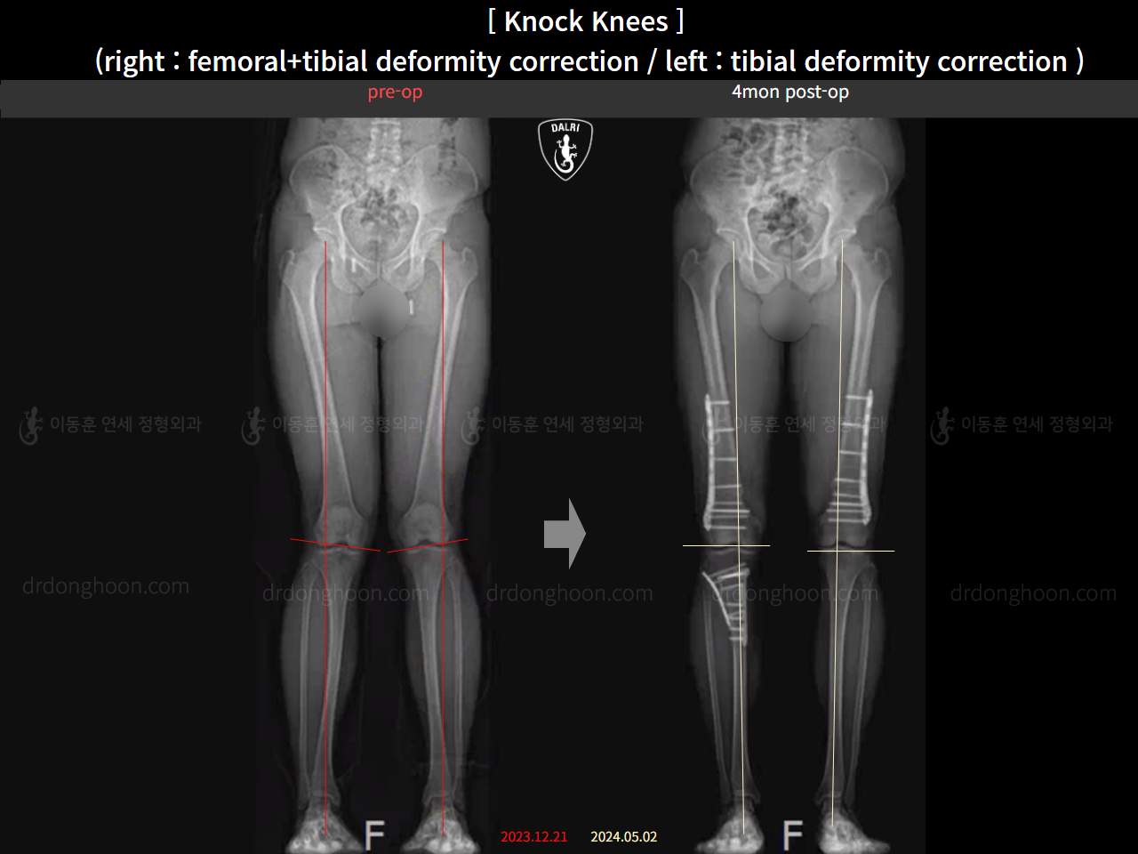 Before and after adult knock knees, case 22759789, image 3, Dr. Donghoon institute (DALRI)