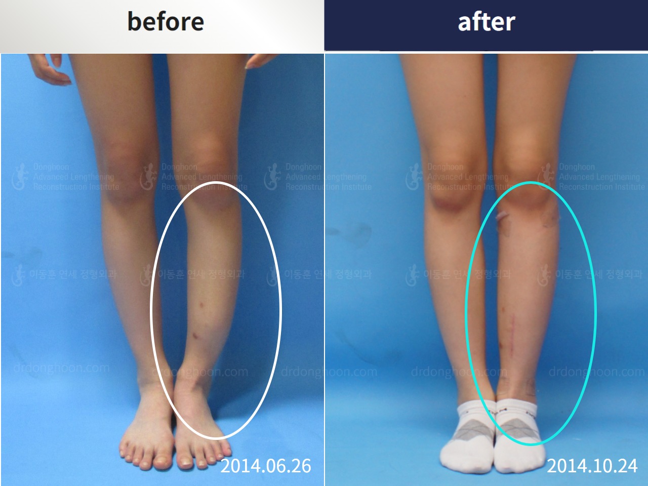 Before and after post-trauma deformity, case 4355008, image 3, Dr. Donghoon institute (DALRI)