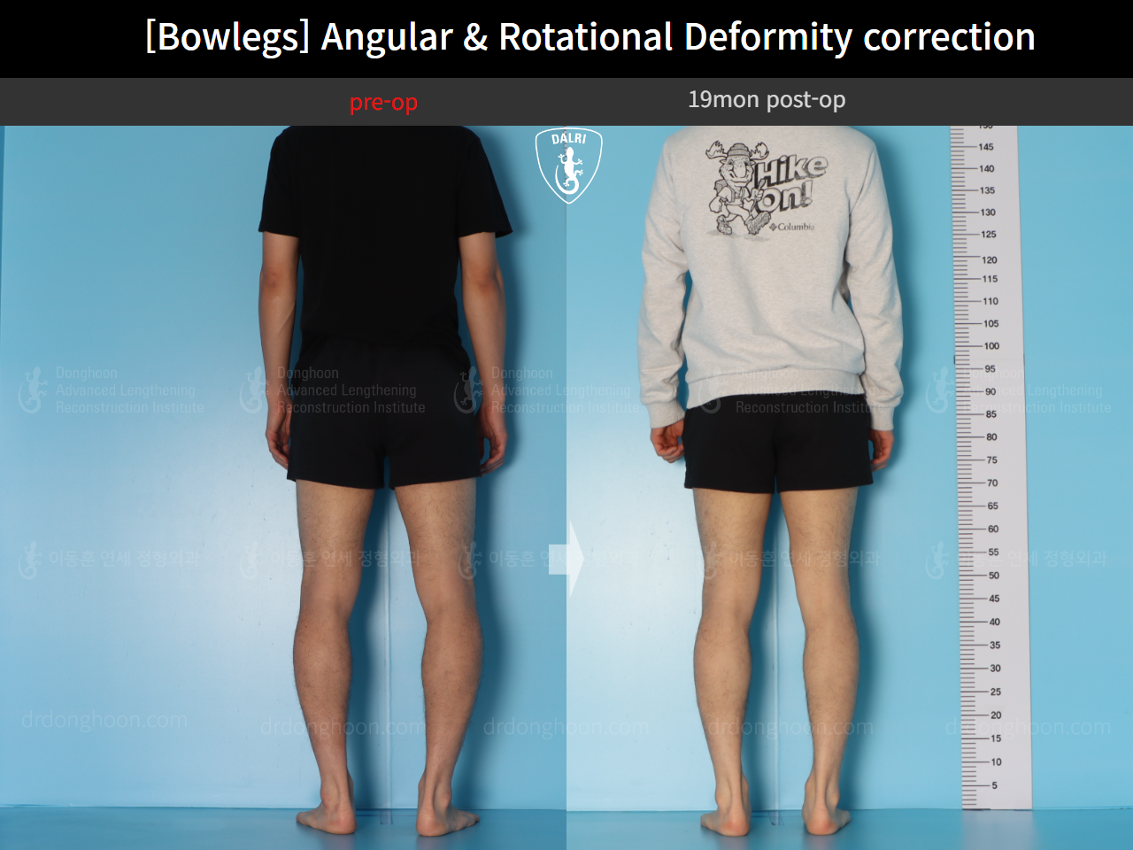 Before and after adult bowlegs, case 18306379, image 6, Dr. Donghoon institute (DALRI)