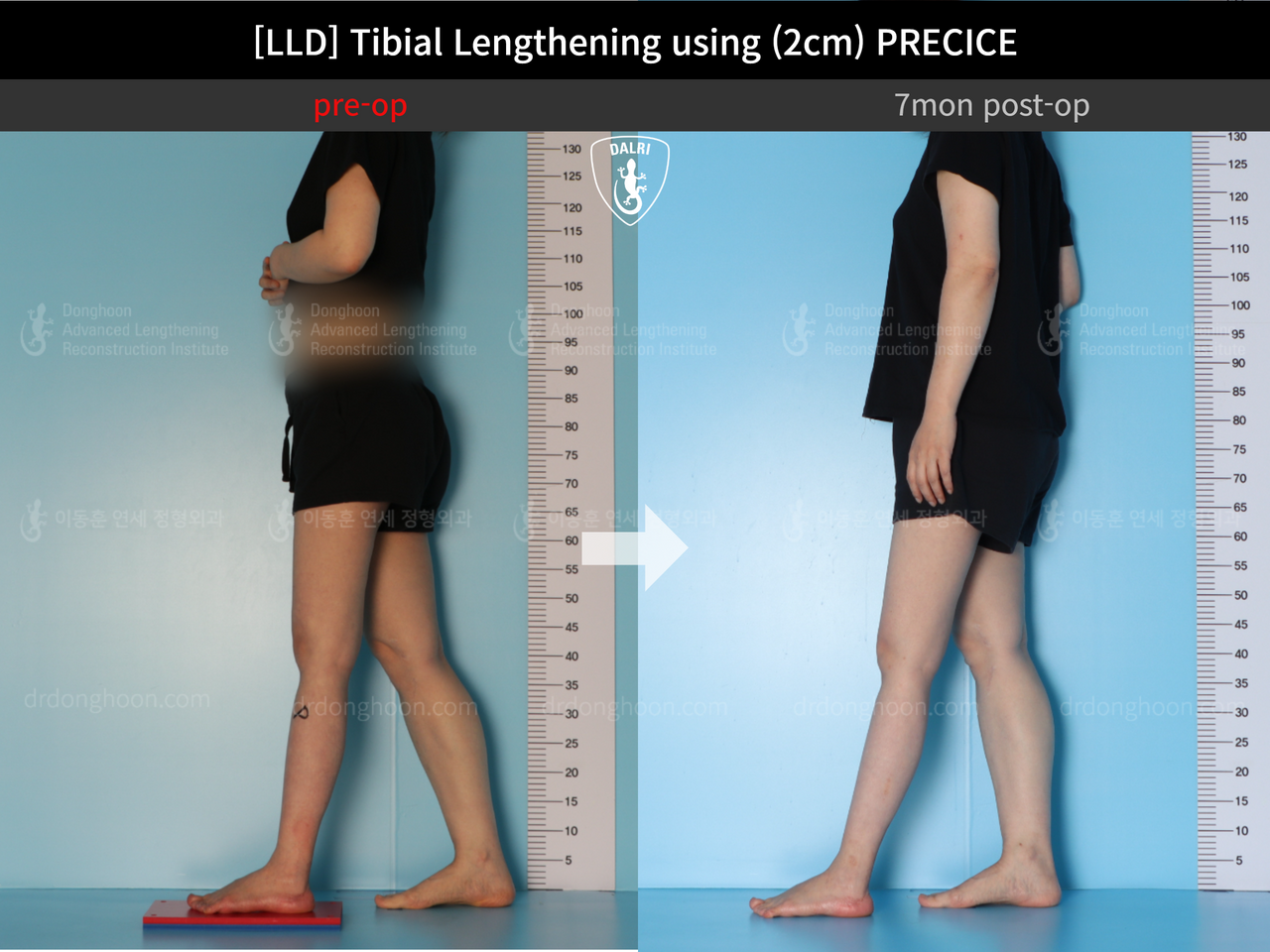 Before and after adult lld, case 12985023, image 3, Dr. Donghoon institute (DALRI)
