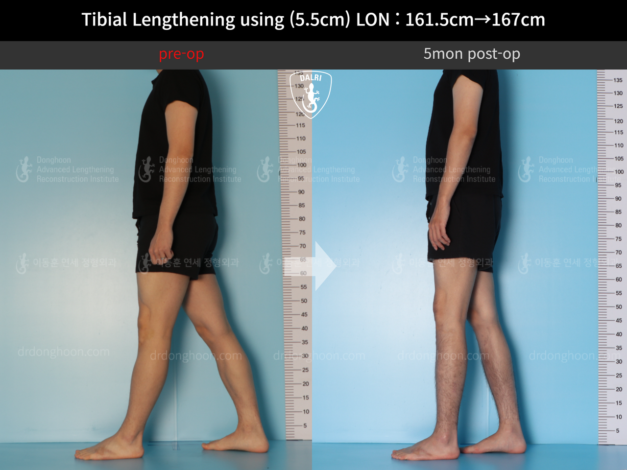 Before and after cll lon, case 12641751, image 4, Dr. Donghoon institute (DALRI)