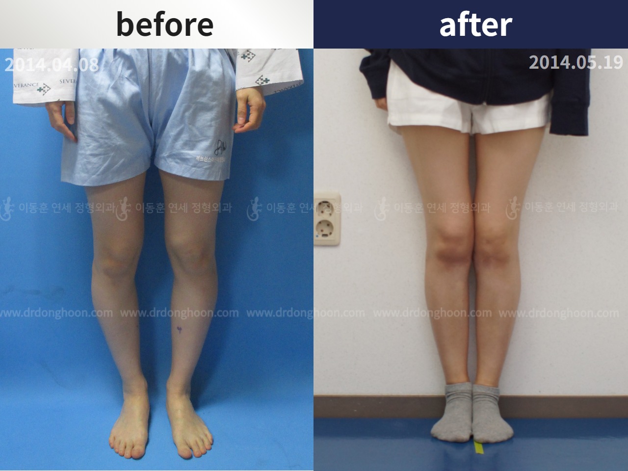 Before and after adult bowlegs, case 4311089, image 1, Dr. Donghoon institute (DALRI)