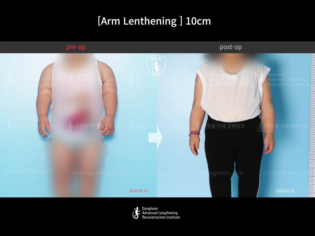 Before and after arm lengthening, case 13578638, image 3, Dr. Donghoon institute (DALRI)