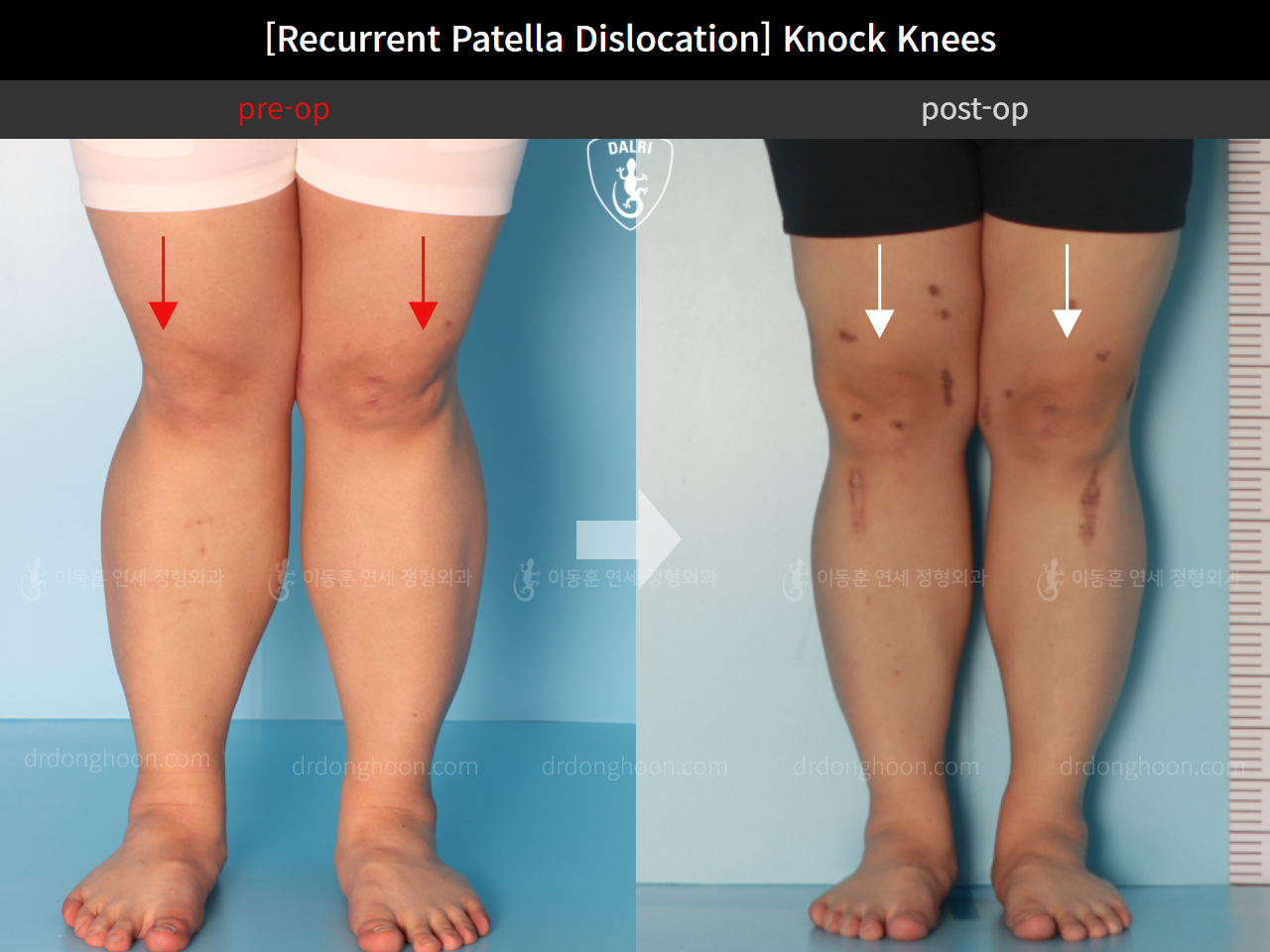 Before and after recurrent patella dislocation, case 10710327, image 6, Dr. Donghoon institute (DALRI)