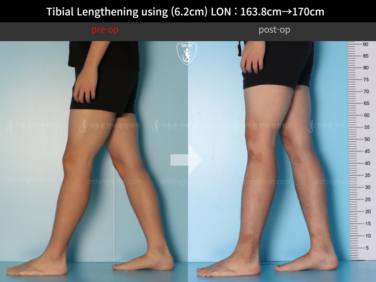 Before and after cll lon, case 13001983, image 7, Dr. Donghoon institute (DALRI)