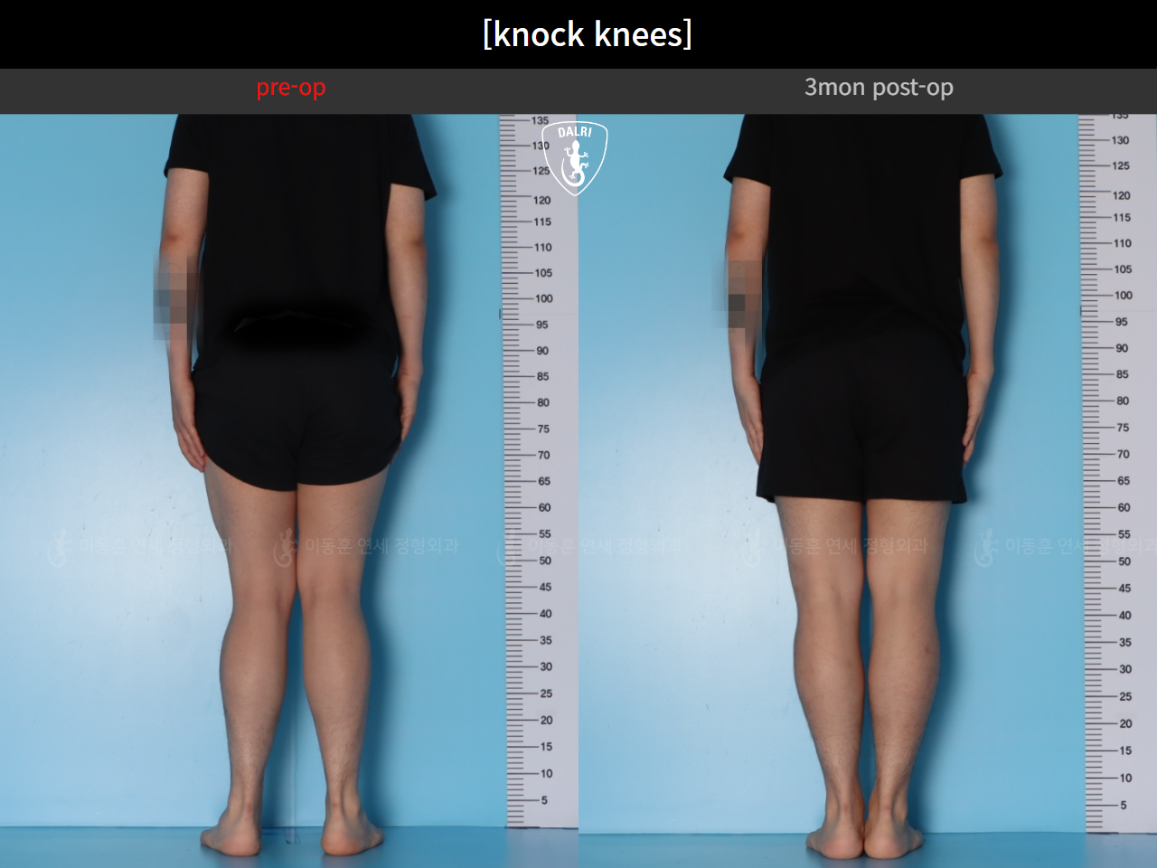 Before and after adult knock knees, case 124642361, image 3, Dr. Donghoon institute (DALRI)