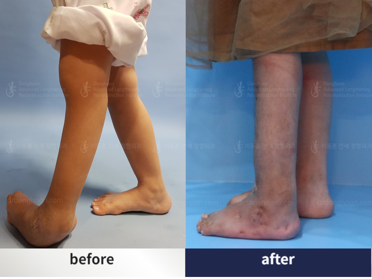 Before and after paediatric congenital condition, case 4304763, image 2, Dr. Donghoon institute (DALRI)