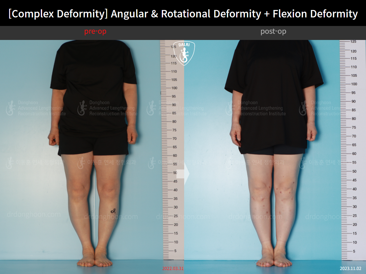 Before and after adult bowlegs, case 16781344, image 1, Dr. Donghoon institute (DALRI)